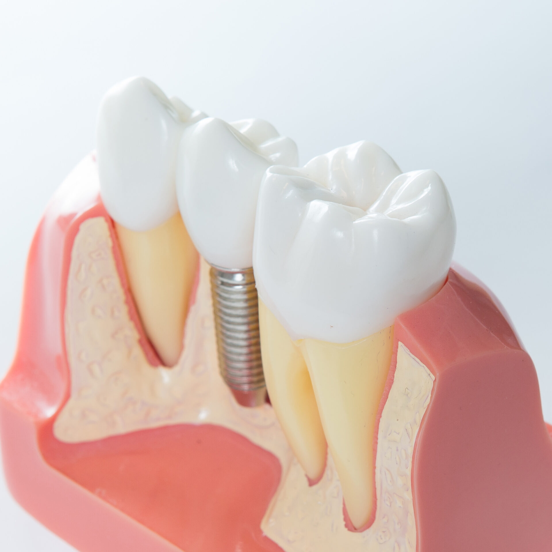Dental Implant Dental Implant