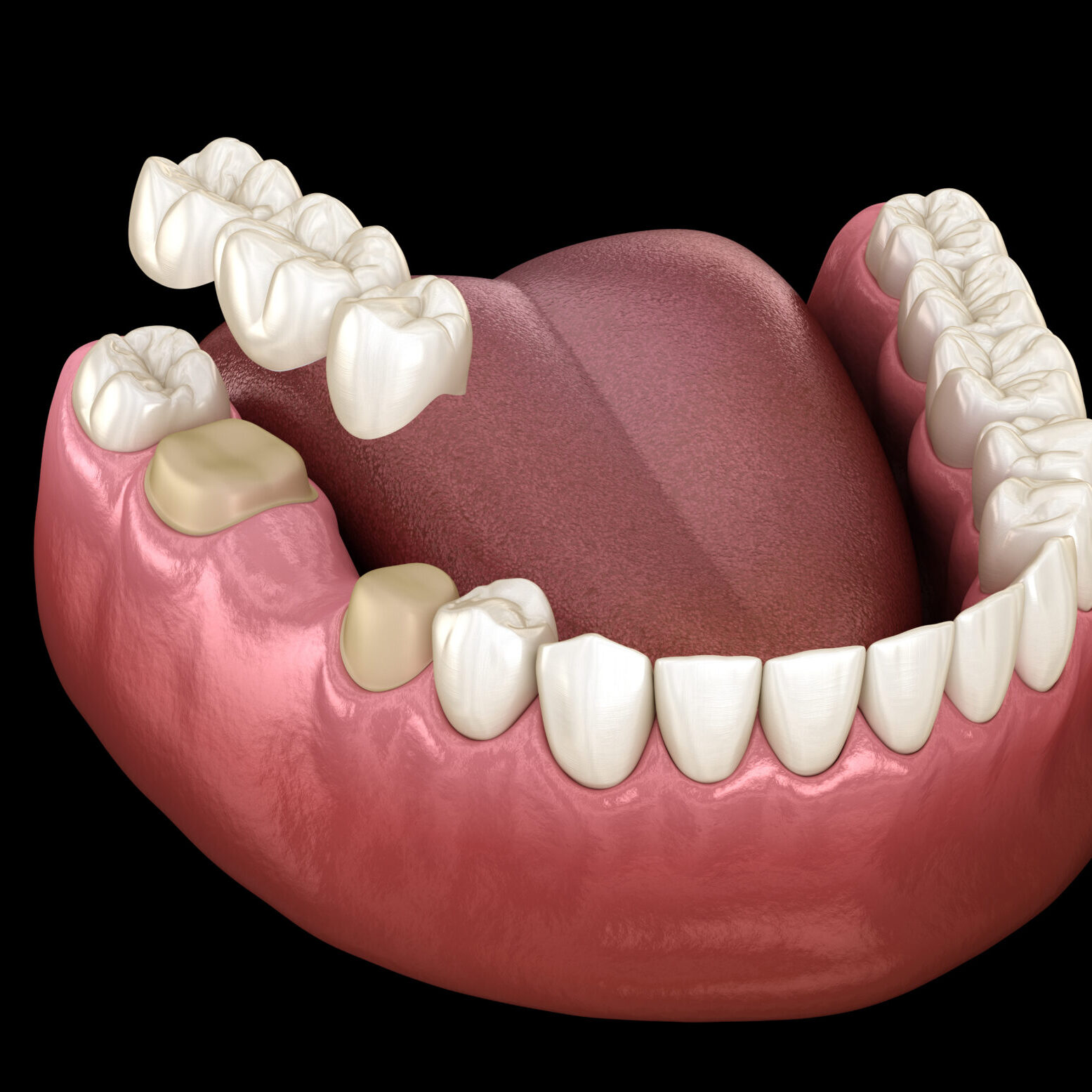 Dental Bridge Of 3 Teeth Over Molar And Premolar. Medically Accurate 3d Illustration Of Human Teeth Treatment Dental Bridge Of 3 Teeth Over Molar And Premolar. Medically Accurate 3d Illustration Of Human Teeth Treatment