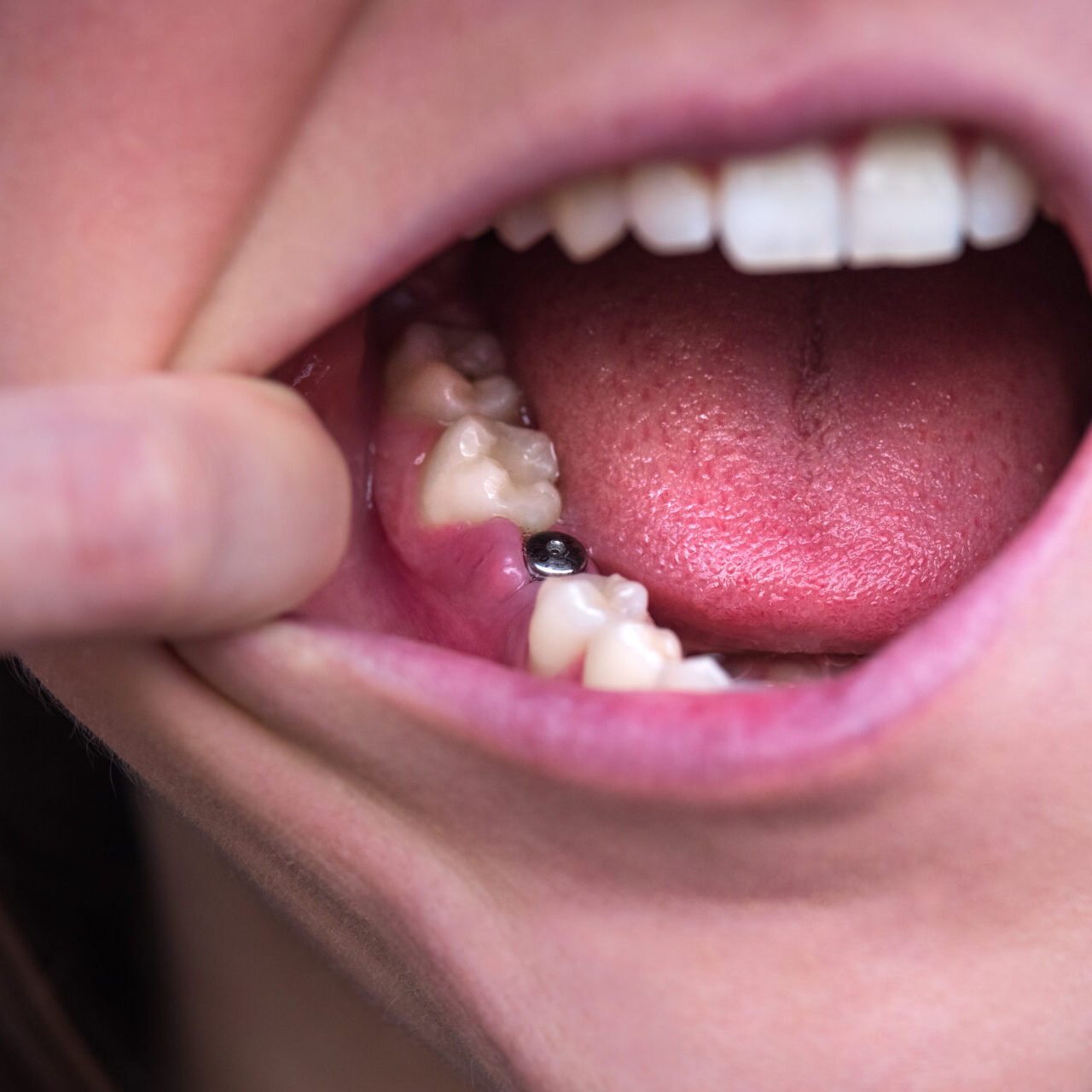 Single Tooth Implant. Young Woman Without Tooth On Lower Jaw. Missing Tooth. Implant After Tooth Extraction Single Tooth Implant. Young Woman Without Tooth On Lower Jaw. Missing Tooth. Implant After Tooth Extraction