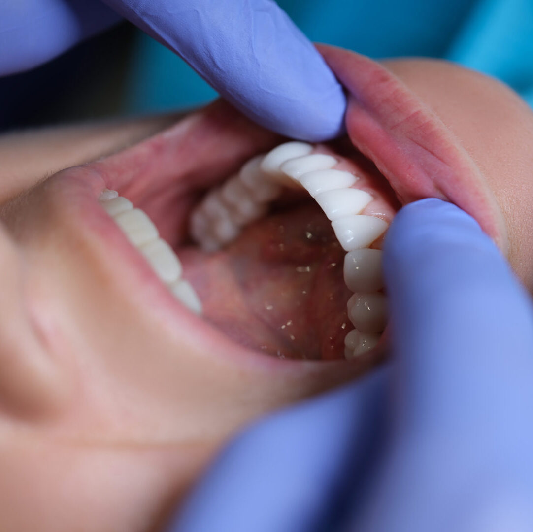 Doctor Dentist Examining Patient Oral Cavity With Veneers Closeup Doctor Dentist Examining Patient Oral Cavity With Veneers Closeup