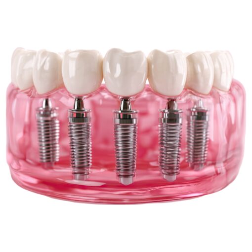 Replacing Several Teeth