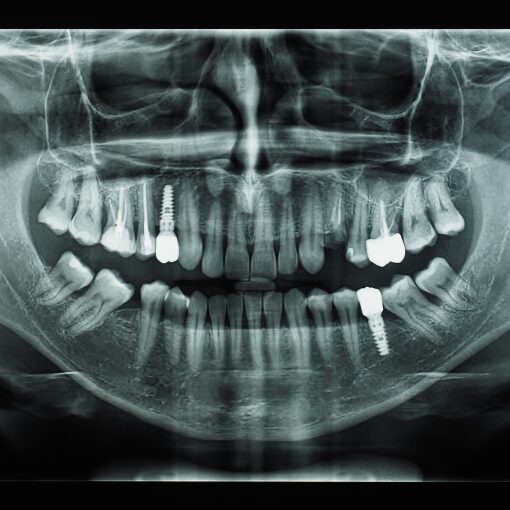 Sinus Augment